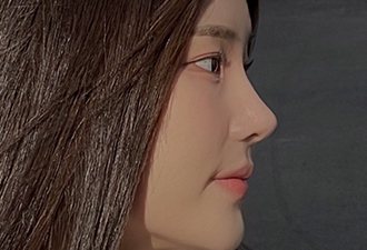 코수술+짧은코+비순각교정+복코+매부리