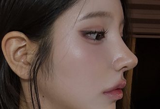 코재수술+매부리+절골+비공내리기+화살코+비순각교정