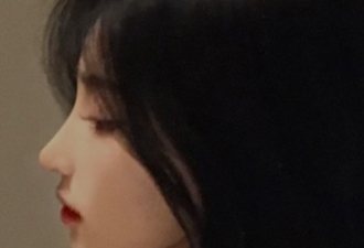 무보형물코수술+매부리+절골+화살코+비순각교정+복코