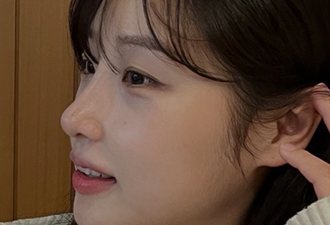 코수술+복코+짧은코+비순각교정+매부리+휜코교정